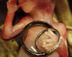 ماجرای دلخراش سقط جنین 14 هفته ای (عکس)