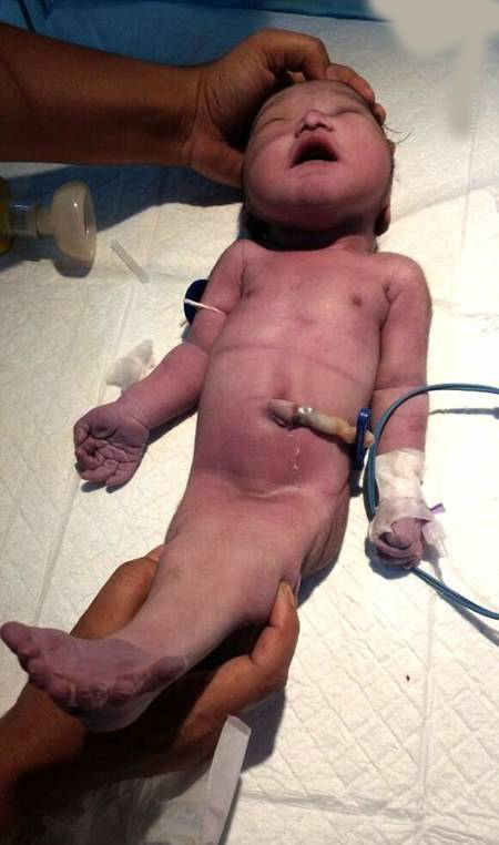 تولد عجیب یک نوزاد شبیه به پری دریایی (عکس)