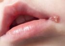 تبخال دهانی و عوامل بروز آن