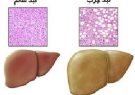 مشکلات کبد چرب در رژیم غذایی