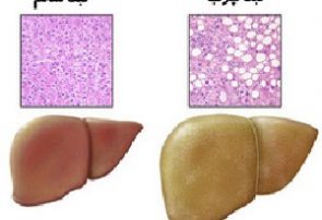 مشکلات کبد چرب در رژیم غذایی