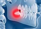دندان عقل و دلایل درد گرفتن آن