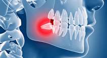 دندان عقل و دلایل درد گرفتن آن